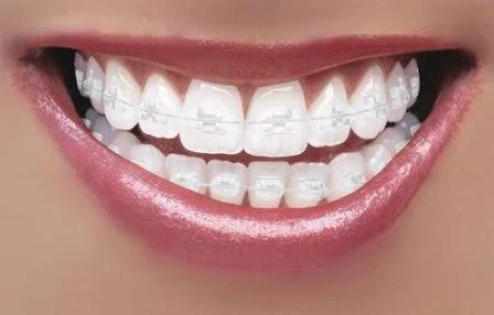 Ceramic braces dental treatment in Dubai UAE