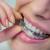 Invisible Braces and Dental Treatment Centre in Dubai