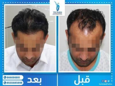 Tunio Aesthetics Hair Transplant